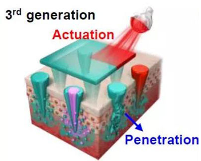 第三代：通过微针介导的皮肤层破坏和微针伴随的各种功能增强药物转运.jpg